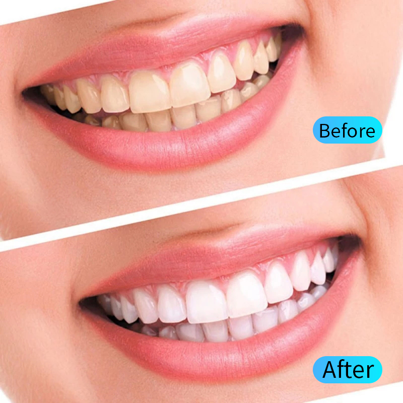 Набор гелей для отбеливания зу – обзор и цена Teeth Whitening Opalescence
