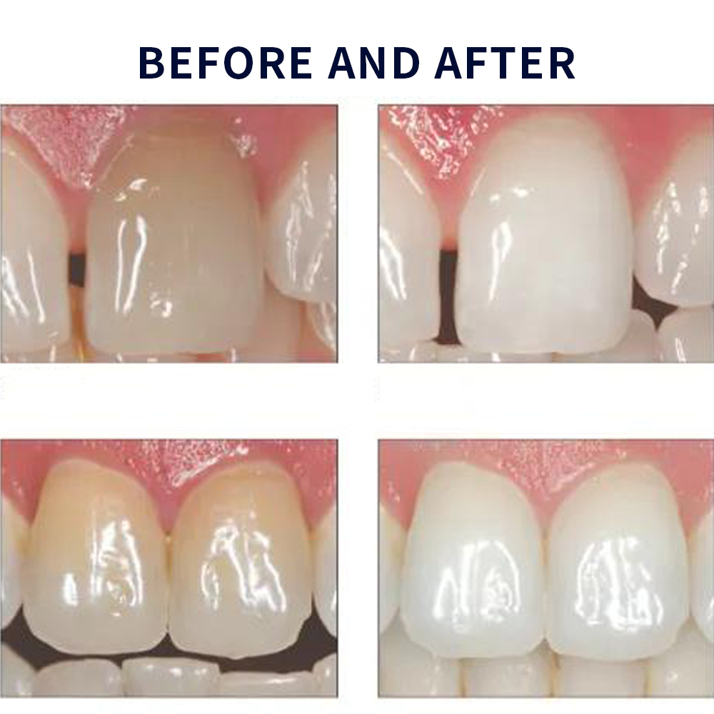 Отбеливающий набор opalution 2 – обзор и цена Teeth Whitening Opalescence