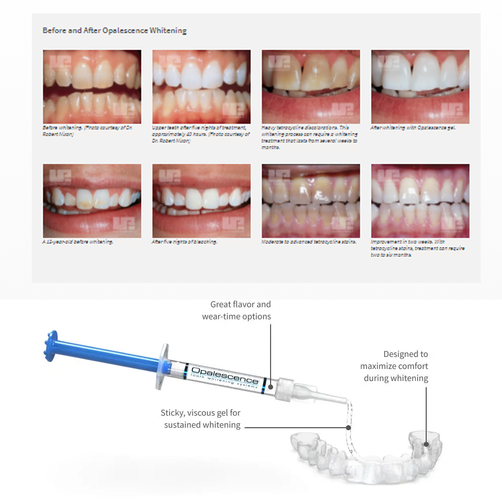 Отбеливающий набор opalution 2 – обзор и цена Teeth Whitening Opalescence