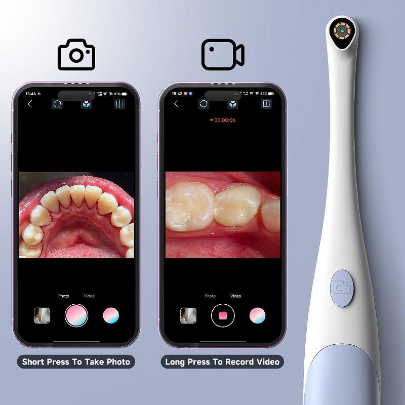 Эндоскопическая камера для осм – обзор и цена Teeth Whitening Video
