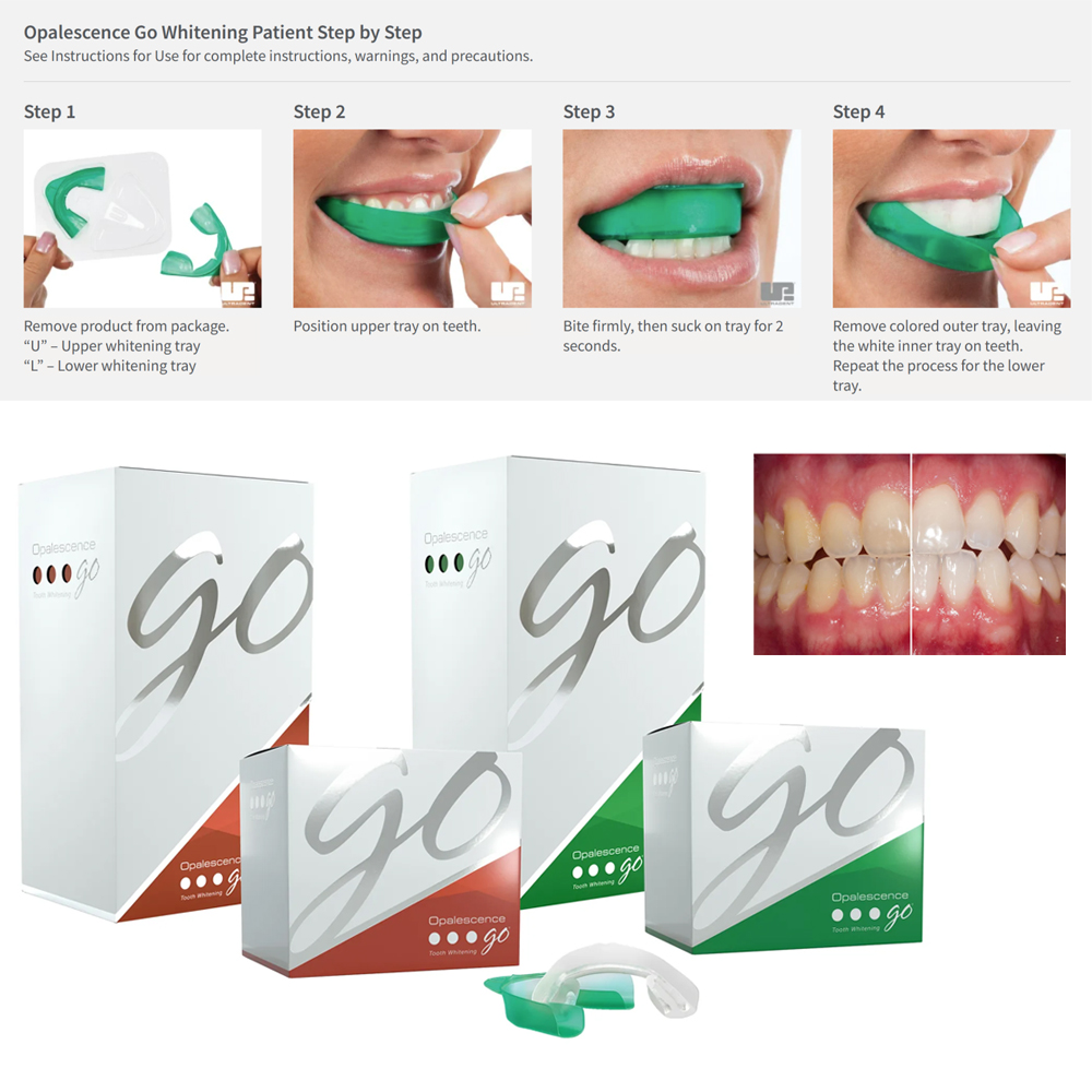 Отбеливающие лотки opalution G – обзор и цена Teeth Whitening Opalescence