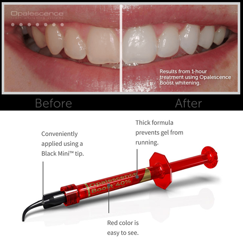Гель для отбеливания зубов Ult – обзор и цена Teeth Whitening Opalescence